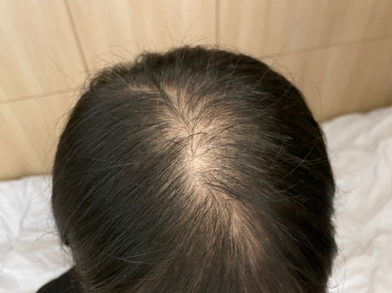 주사 시술전
