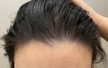 치료 받은 직후 사진