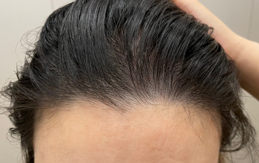 치료 받은 직후 사진