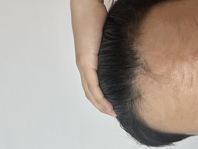 M자 탈모 잔머리가 자라고 있는걸까요?