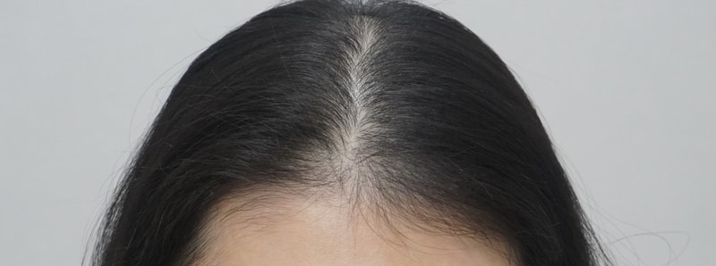 뉴헤어부산의원 에서 4회차 탈모 치료 후기