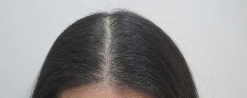 뉴헤어부산의원에서 치료 받은 지 8회 차 입니다