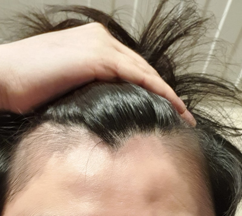 조합약 2개월째 효과 제대로 보고 있습니다.