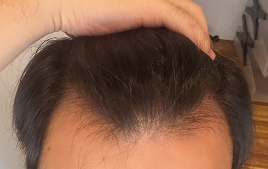 M자 로게인폼 2달경과(효과 좋네요)