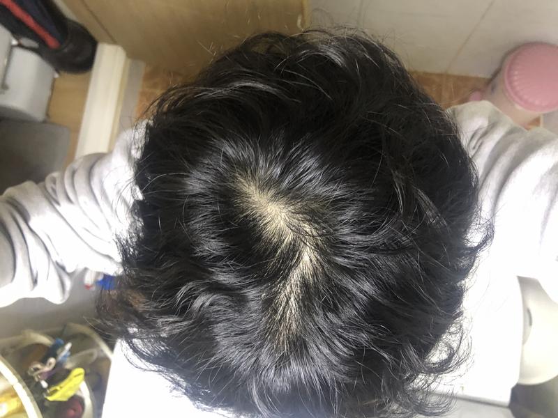 もうすぐ大人になる高校生ですが、脱毛でしょうか