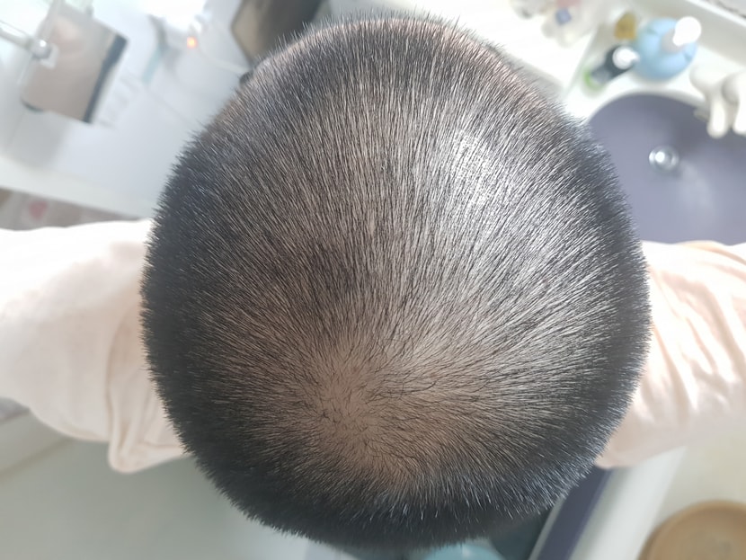 11개월 후 다시 반삭