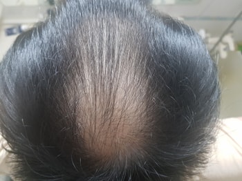 3개월 후 멘붕. 미녹시딜 다시 사용