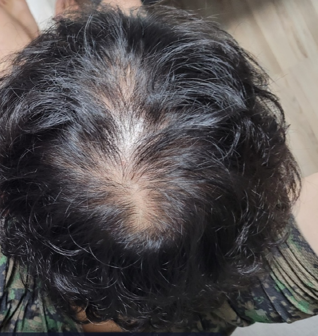 管理脱发已有9个月