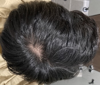 평상시 머리(조명때문에 붉어보이는데 지루성 두피염은 없습니다)