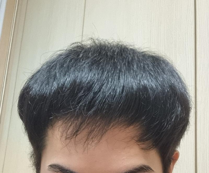 엑소좀 주사가 효과가 있는 걸까요?