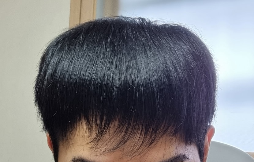 엑소좀 주사를 맞은 이후