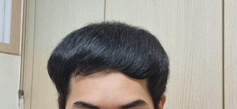 엑소좀 주사를 맞기 전