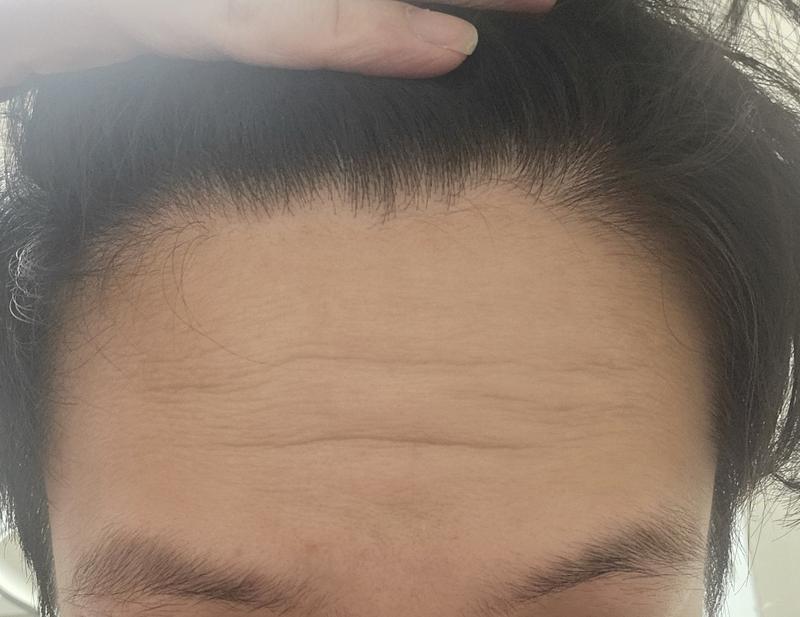 저 m자 탈모인가요??