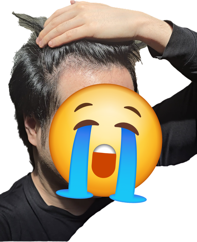 27살 탈모 너무 힘드네요