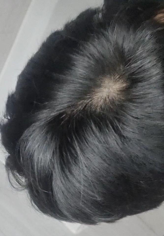 탈모 관리 5년차입니다