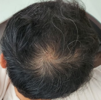 주사 한번 맞고난 사진입니다.