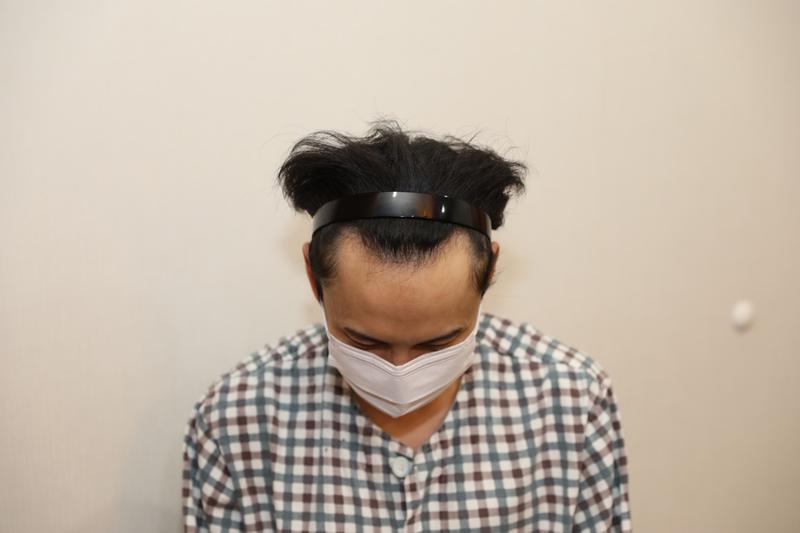 왜 모발이식 하라는지 이제 알겠다(M자 샴푸 후 사진)