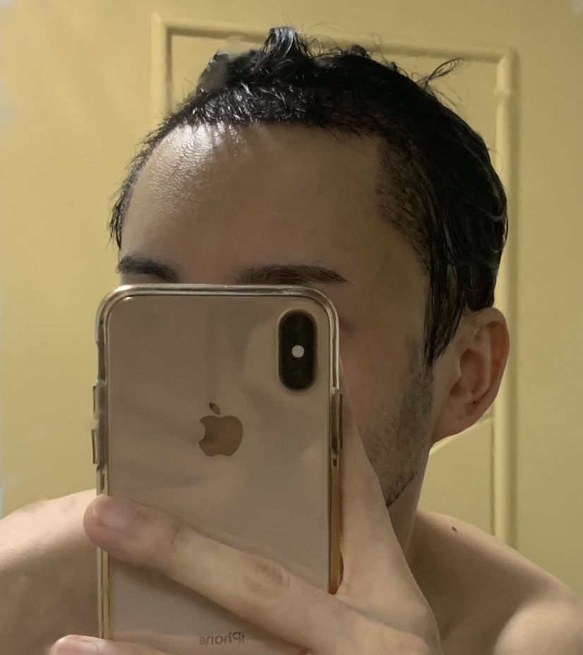 수술 후 4일차. 아직 이마 붓기 덜 빠짐(샴푸 후)