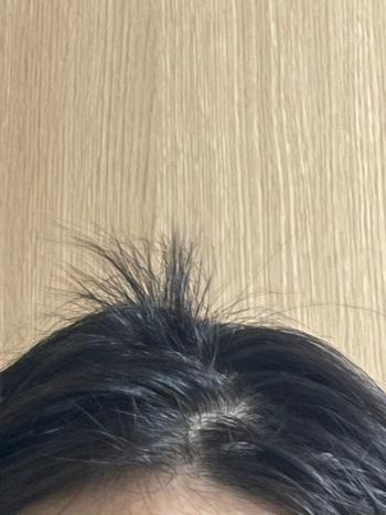 원형탈모
