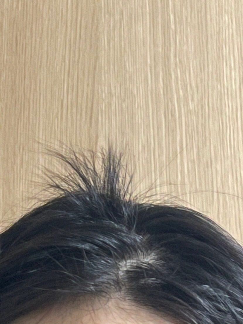 원형탈모