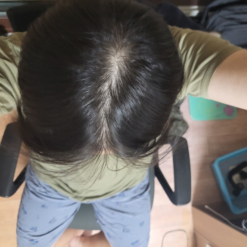결국 탈모 인정할때가 된거 같아요..