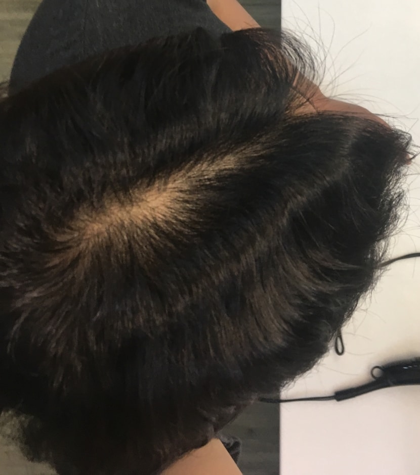 한쪽만 가르마 타면 가르마 탄 부분 모발이 탈락될 확률이 높다구 해서 몇개월전부터는 가르마 방향을 바꿔봤는데 이젠 이쪽 방향도 하얗게 변하는 중이예요 ㅠㅠㅠ