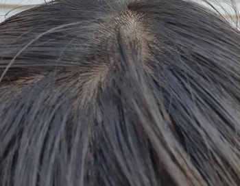 이것은 4년전 두피 상태입니다.