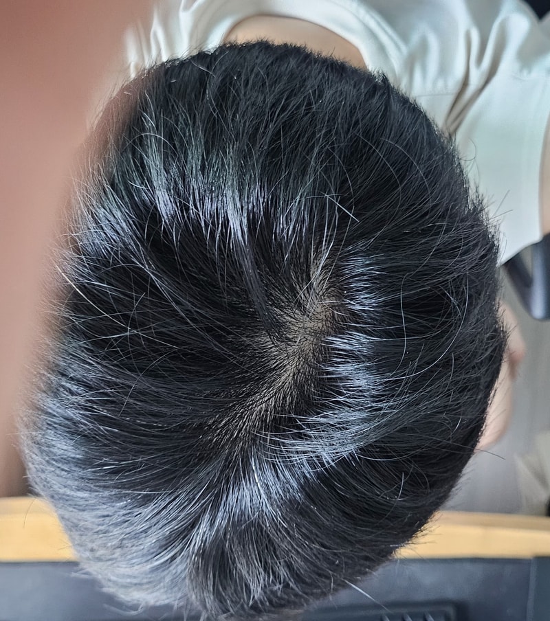 31歳の男性の脱毛でしょうか？