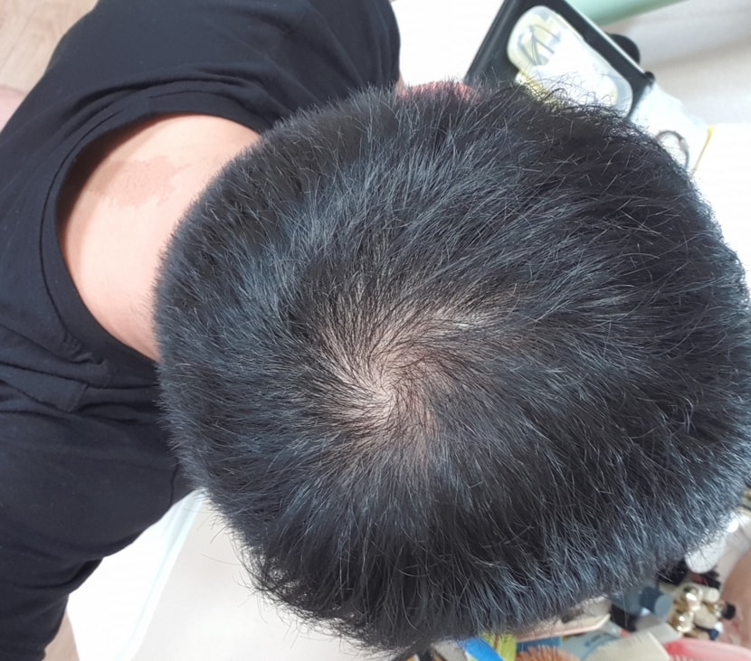정수리 사진이요ㅠ