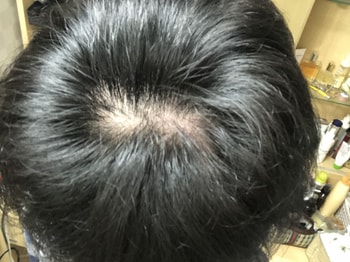 3개월 전 중단 후 수술하고 다시 약복용 시작했을때