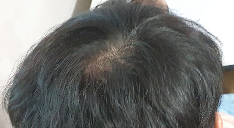 길가다가 보면 딱봐도 탈모라고 느끼겠죠...?ㅠㅠ