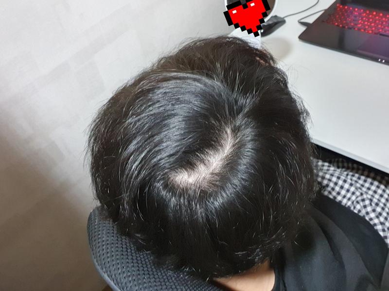 24살인데 호전될수있을까요?ㅠㅠㅠ