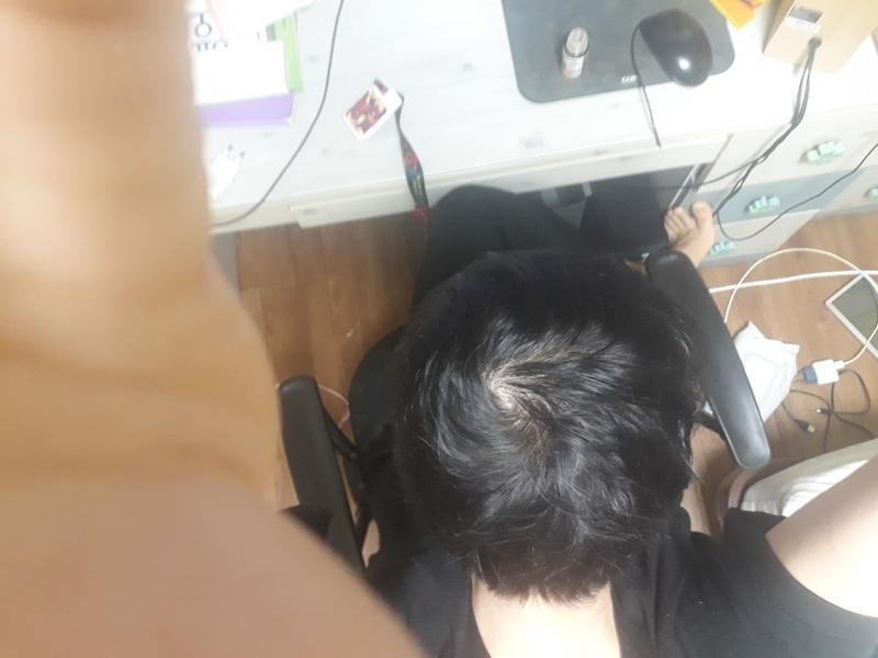 25살 탈모약 7개월 후기입니다. 4년전에 9개월 복용하다가 끊고 5월달부터 복용했습니다.