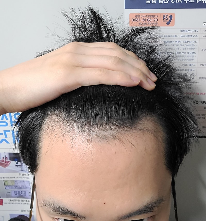 프로페시아 8개월차 객관적 평가 부탁드립니다