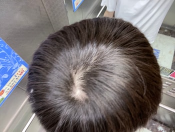 정수리 사진(머리 감았을 때)