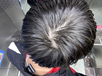 정수리 사진(머리 젖었을 때)