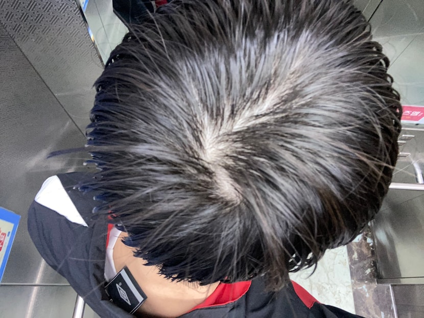 정수리 사진(머리 젖었을 때)