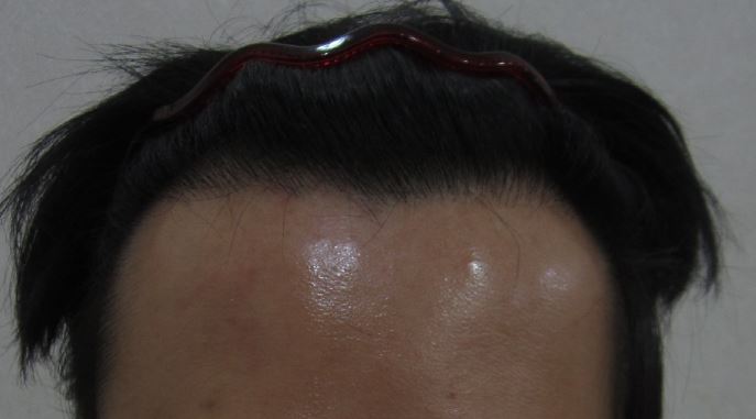 수술 전