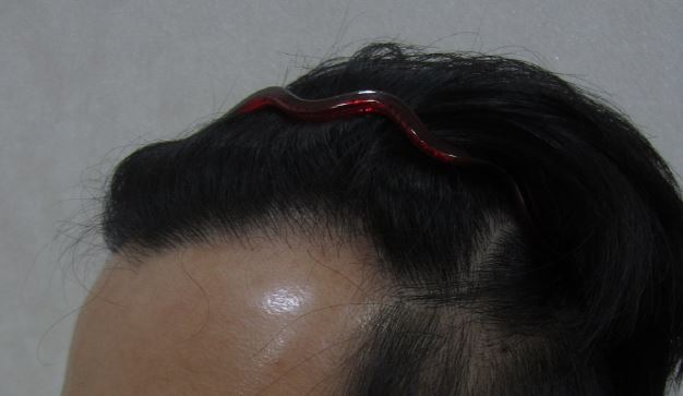 수술 전(L)