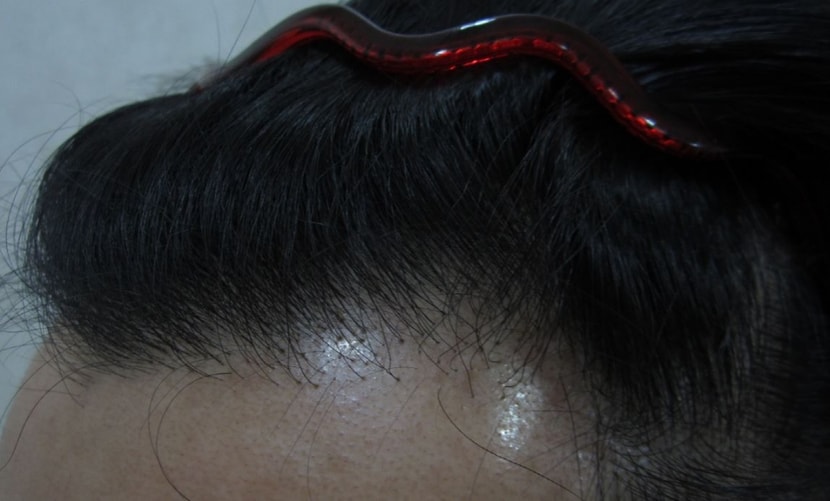 수술 전(L)