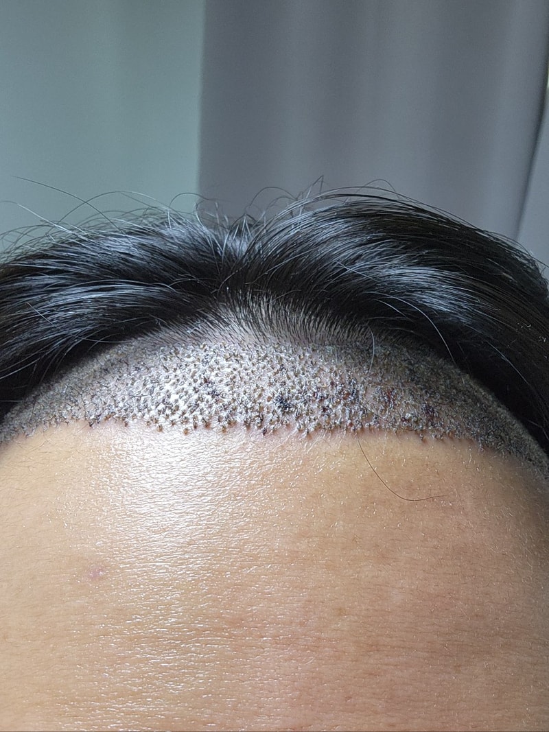 모발이식 일주일차인데 머리카락이 잘 안올라오는 느낌이네요