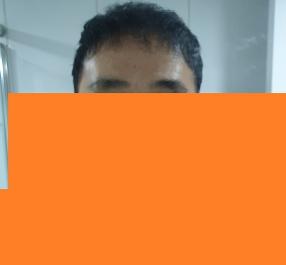 모발이식8개월차