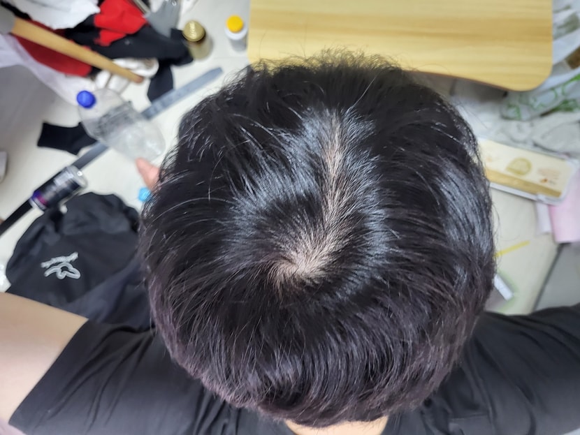 저 정수리 탈모인가요?? 