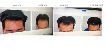 비포에프터