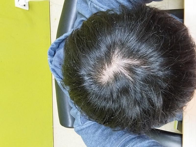 아니 탈모냐고 물어보니까, 지켜봐야한다 이딴소리만 해대는데
