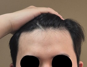 m자+헤어라인 모발이식 이정도면 잘된건가요?