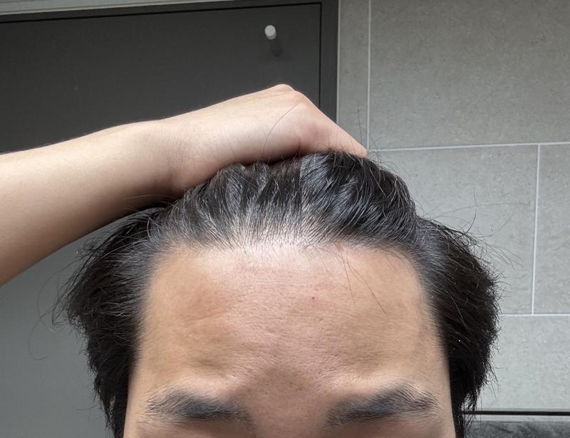 탈모가 얼마나 진행된건지 궁금합니다.