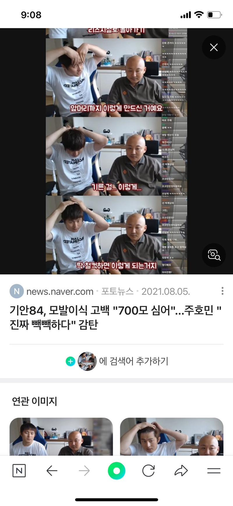 Kian 84 Hair Transplantation