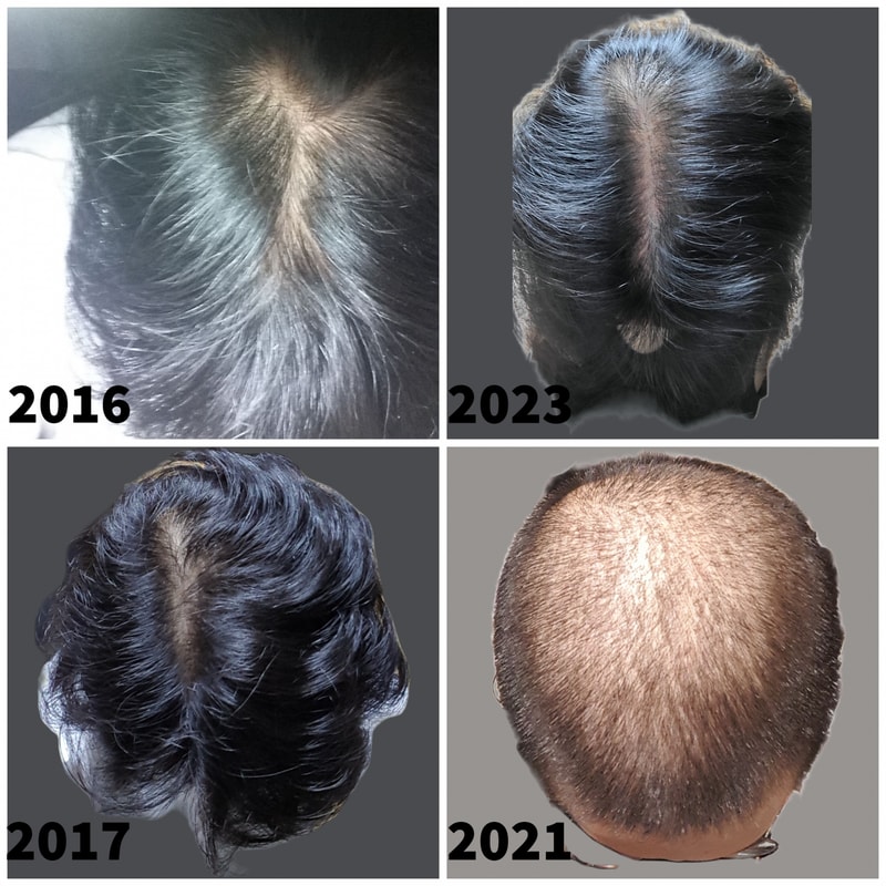 I'm going to lose hair, right?