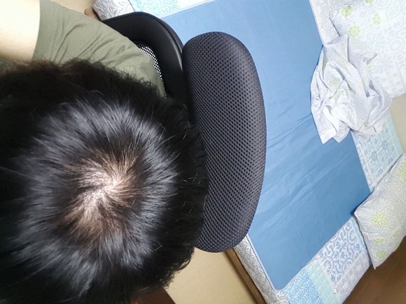 2년 전 약 먹기 전 정수리